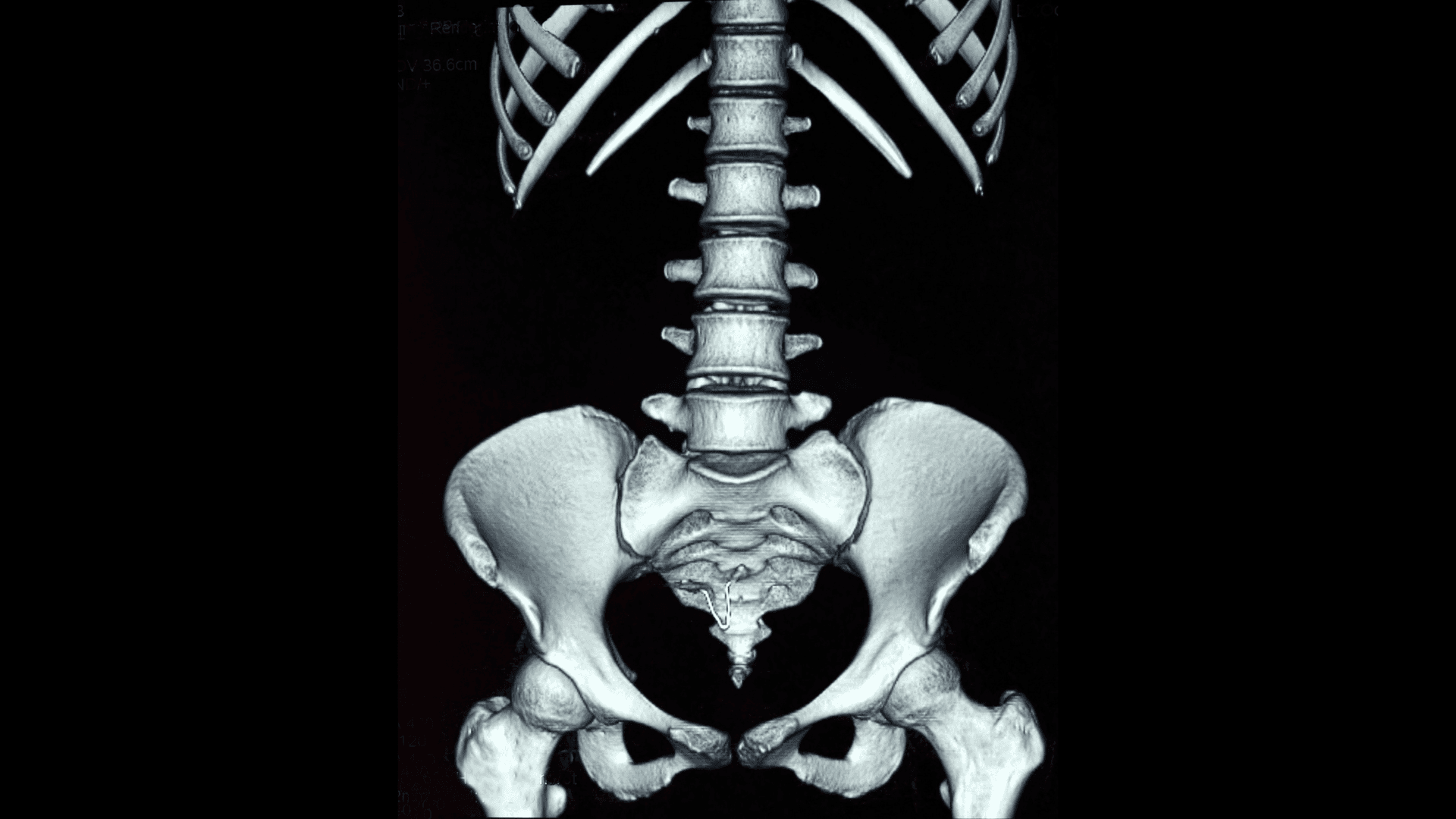 Abdominal X-Ray