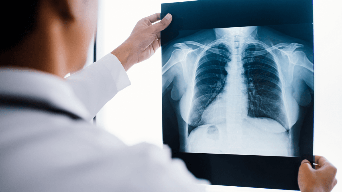 What Is a Chest X-Ray and Why Is It Done?