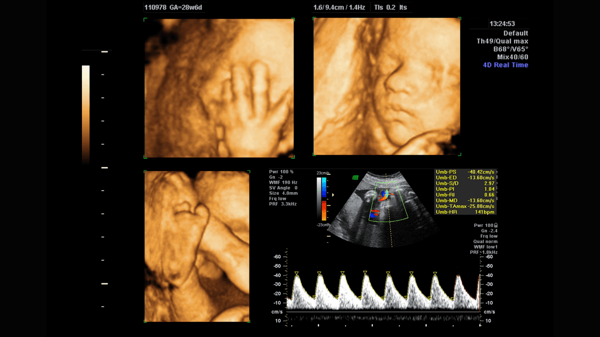 Everything You Need to Know About 3D & 4D Ultrasound Scans